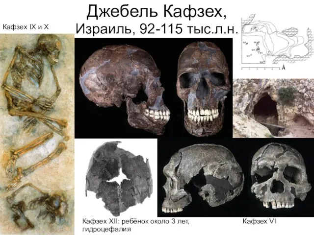 Кафзех XII: ребёнок около 3 лет, гидроцефалия Кафзех IX и X Кафзех