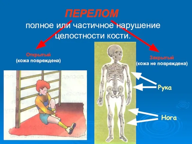 полное или частичное нарушение целостности кости. Рука ПЕРЕЛОМ Нога Открытый (кожа повреждена) Закрытый (кожа не повреждена)