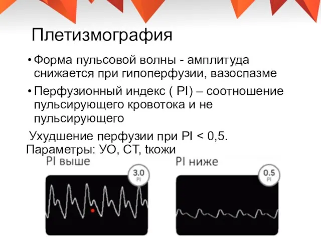 Плетизмография Форма пульсовой волны - амплитуда снижается при гипоперфузии, вазоспазме Перфузионный индекс