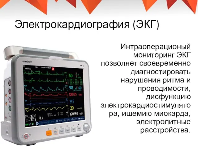 Электрокардиография (ЭКГ) Интраоперационый мониторинг ЭКГ позволяет своевременно диагностировать нарушения ритма и проводимости,