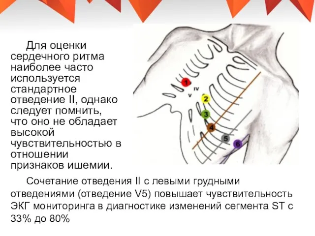 Для оценки сердечного ритма наиболее часто используется стандартное отведение II, однако следует