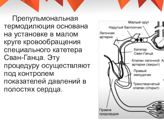 Препульмональная термодилюция основана на установке в малом круге кровообращения специального катетера Сван-Ганца.