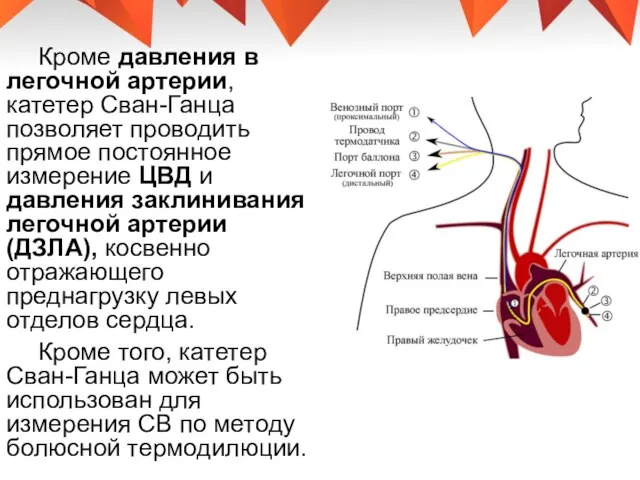 Кроме давления в легочной артерии, катетер Сван-Ганца позволяет проводить прямое постоянное измерение