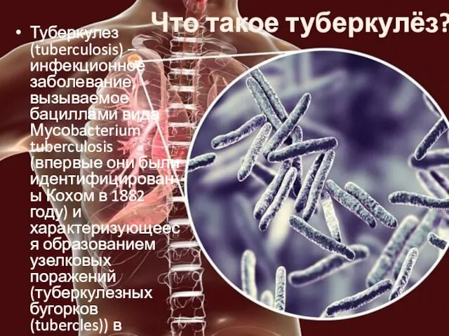 Что такое туберкулёз? Туберкулез (tuberculosis) – инфекционное заболевание, вызываемое бациллами вида Мусоbacterium