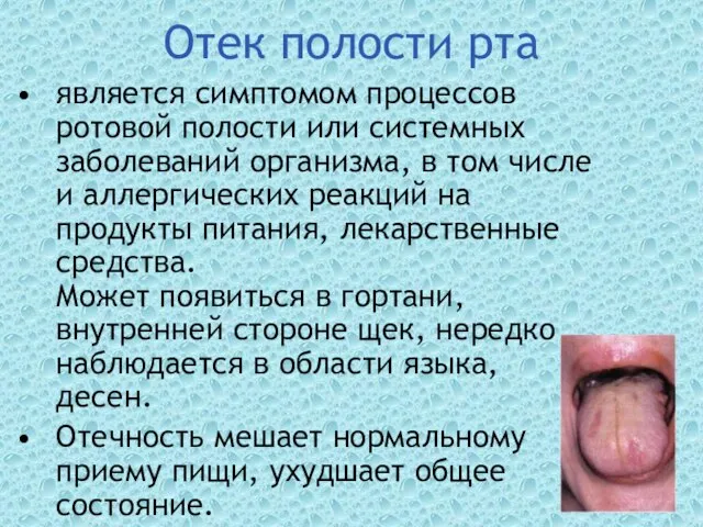 Отек полости рта является симптомом процессов ротовой полости или системных заболеваний организма,