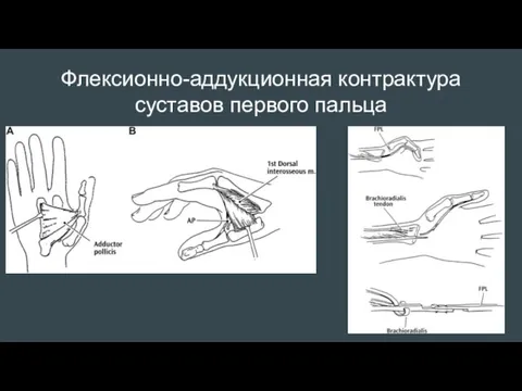 Флексионно-аддукционная контрактура суставов первого пальца