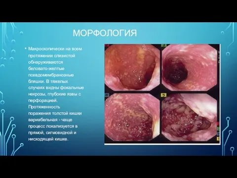 МОРФОЛОГИЯ Макроскопически на всем протяжении слизистой обнаруживаются беловато-желтые псевдомембранозные бляшки. В тяжелых