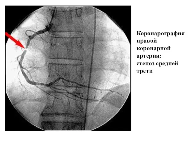 Коронарография правой коронарной артерии: стеноз средней трети