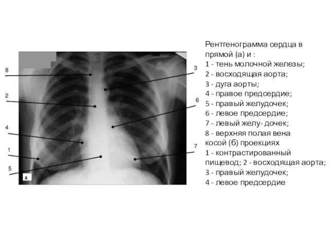 Рентгенограмма сердца в прямой (а) и : 1 - тень молочной железы;