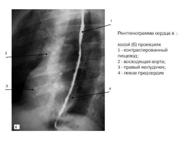 Рентгенограмма сердца в : косой (б) проекциях 1 - контрастированный пищевод; 2
