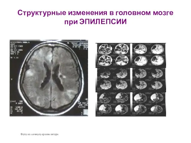 Структурные изменения в головном мозге при ЭПИЛЕПСИИ Фото из личного архива автора