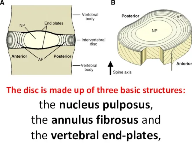 The disc is made up of three basic structures: the nucleus pulposus,