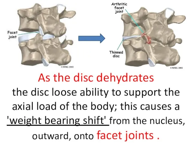 As the disc dehydrates the disc loose ability to support the axial