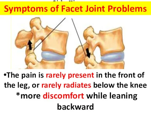 Symptoms of Facet Joint Problems a persisting point of tenderness overlying the