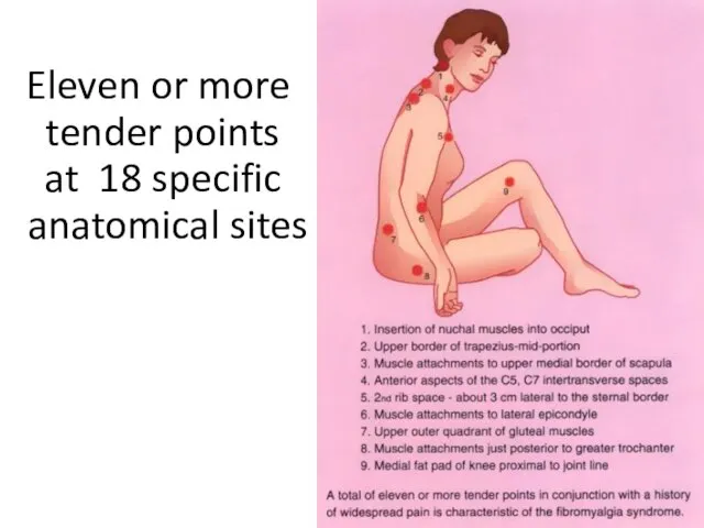 Eleven or more tender points at 18 specific anatomical sites