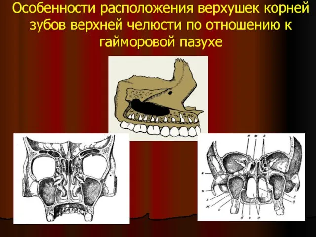 Особенности расположения верхушек корней зубов верхней челюсти по отношению к гайморовой пазухе