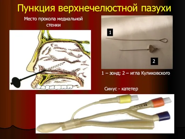 Пункция верхнечелюстной пазухи Место прокола медиальной стенки Синус - катетер 1 2