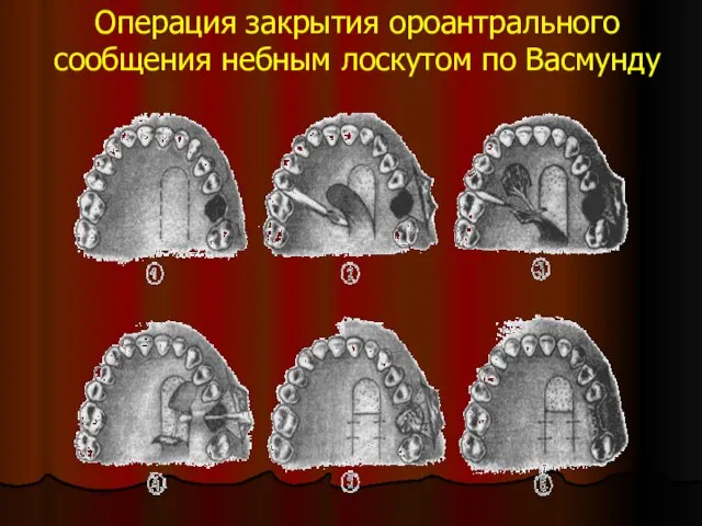 Операция закрытия ороантрального сообщения небным лоскутом по Васмунду