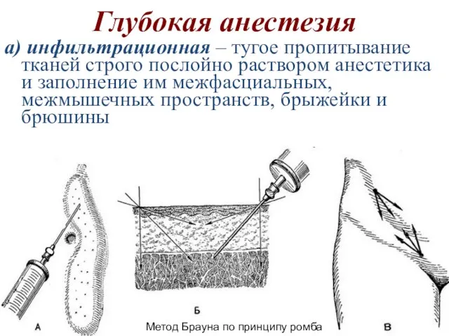 Глубокая анестезия а) инфильтрационная – тугое пропитывание тканей строго послойно раствором анестетика