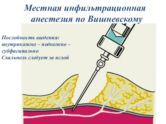 Местная инфильтрационная анестезия по Вишневскому Послойность введения: внутрикожно – подкожно – субфасциально Скальпель следует за иглой