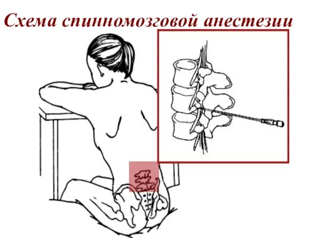 Схема спинномозговой анестезии