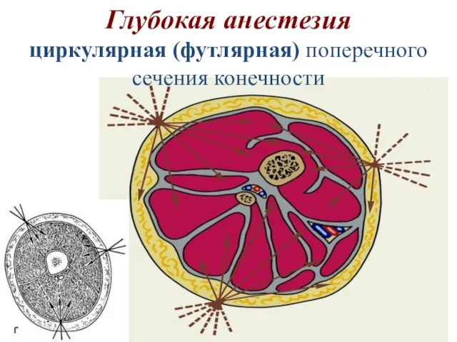 Глубокая анестезия циркулярная (футлярная) поперечного сечения конечности