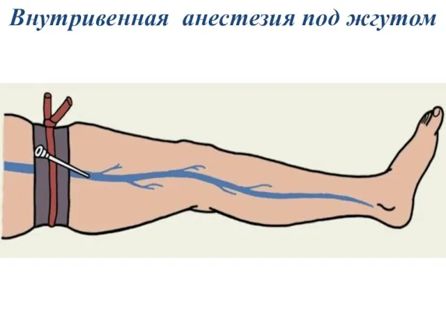 Внутривенная анестезия под жгутом