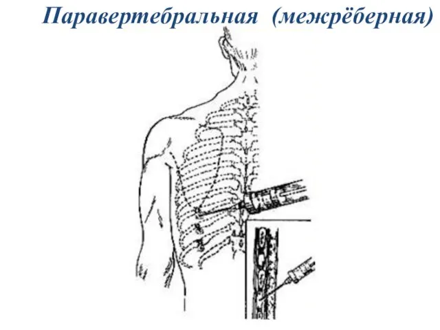 Паравертебральная (межрёберная)