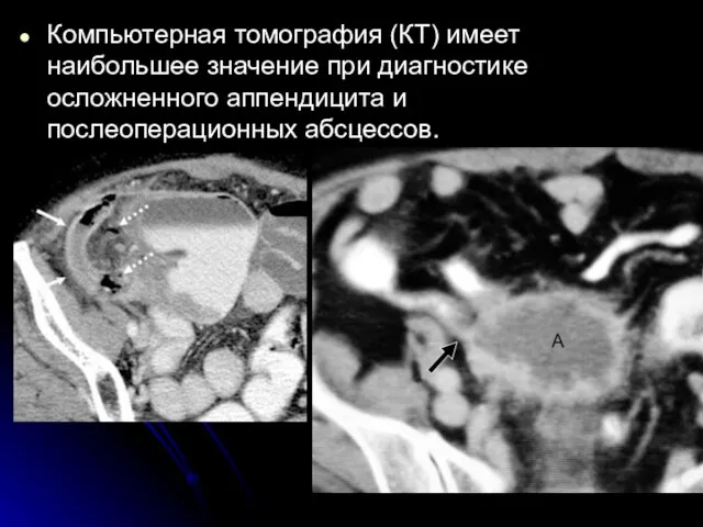 Компьютерная томография (КТ) имеет наибольшее значение при диагностике осложненного аппендицита и послеоперационных абсцессов.