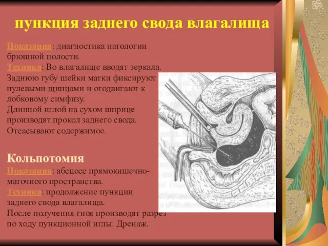 пункция заднего свода влагалища Показания: диагностика патологии брюшной полости. Техника: Во влагалище