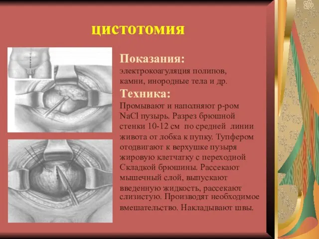 цистотомия Показания: электрокоагуляция полипов, камни, инородные тела и др. Техника: Промывают и