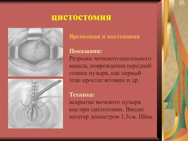 цистостомия Временная и постоянная Показания: Разрывы мочеиспускательного канала, повреждения передней стенки пузыря,