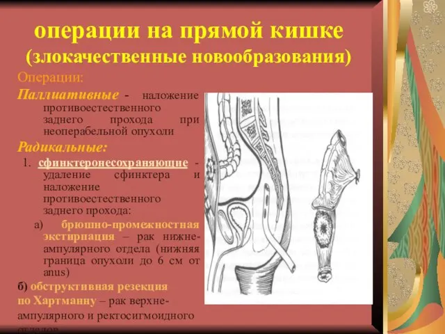 операции на прямой кишке (злокачественные новообразования) Операции: Паллиативные - наложение противоестественного заднего