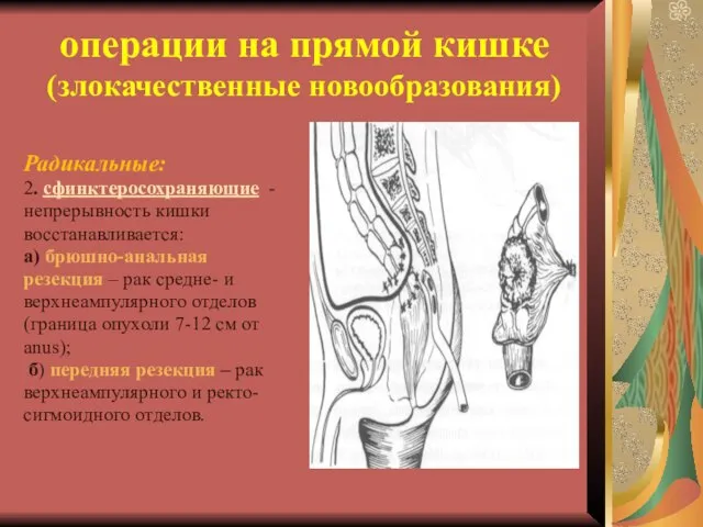 операции на прямой кишке (злокачественные новообразования) Радикальные: 2. сфинктеросохраняющие - непрерывность кишки