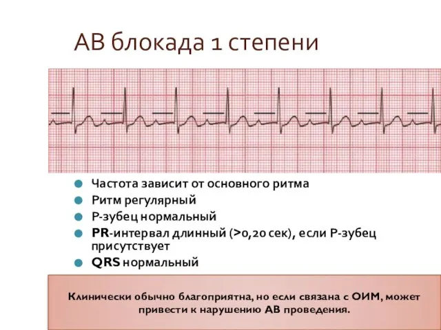 АВ блокада 1 степени Частота зависит от основного ритма Ритм регулярный Р-зубец