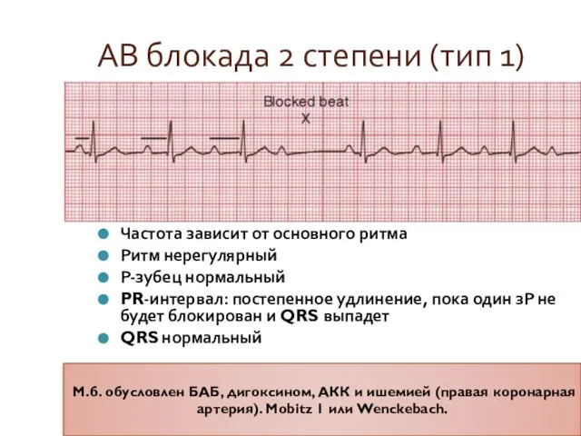 АВ блокада 2 степени (тип 1) Частота зависит от основного ритма Ритм