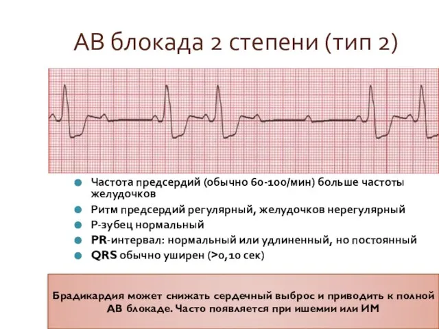 АВ блокада 2 степени (тип 2) Частота предсердий (обычно 60-100/мин) больше частоты