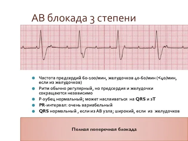 АВ блокада 3 степени Частота предсердий 60-100/мин, желудочков 40-60/мин ( Ритм обычно