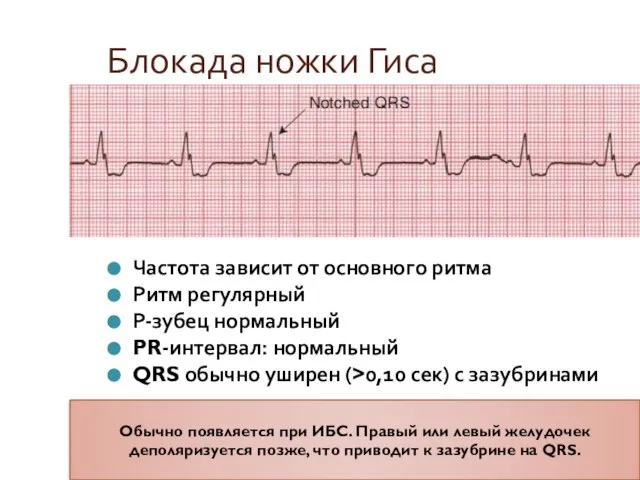 Блокада ножки Гиса Частота зависит от основного ритма Ритм регулярный Р-зубец нормальный