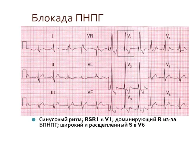 Блокада ПНПГ Синусовый ритм; RSR1 в V1; доминирующий R из-за БПНПГ; широкий