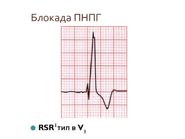 Блокада ПНПГ RSR1тип в V1