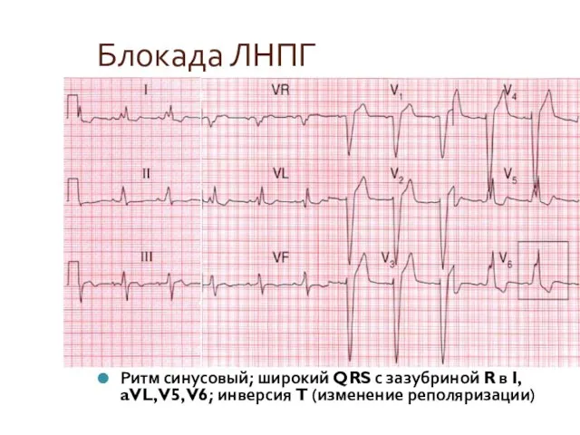 Блокада ЛНПГ Ритм синусовый; широкий QRS с зазубриной R в I, aVL,