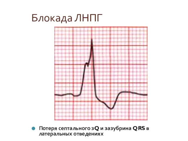 Блокада ЛНПГ Потеря септального зQ и зазубрина QRS в латеральных отведениях