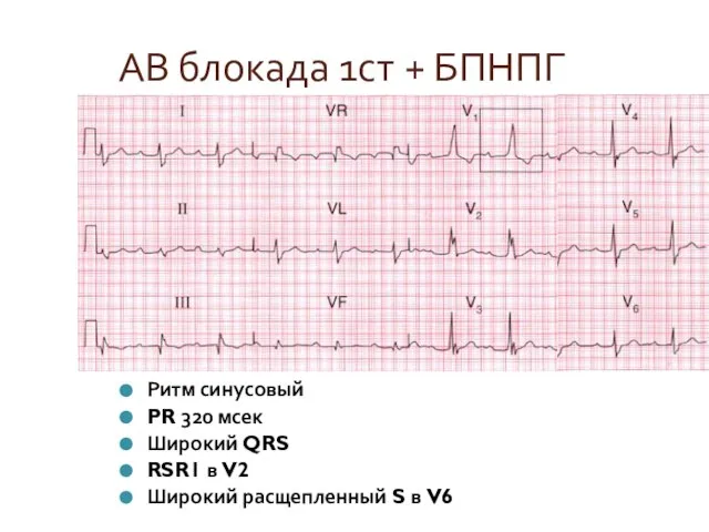 АВ блокада 1ст + БПНПГ Ритм синусовый PR 320 мсек Широкий QRS