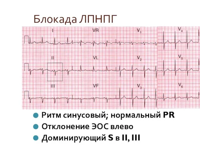 Блокада ЛПНПГ Ритм синусовый; нормальный PR Отклонение ЭОС влево Доминирующий S в II, III