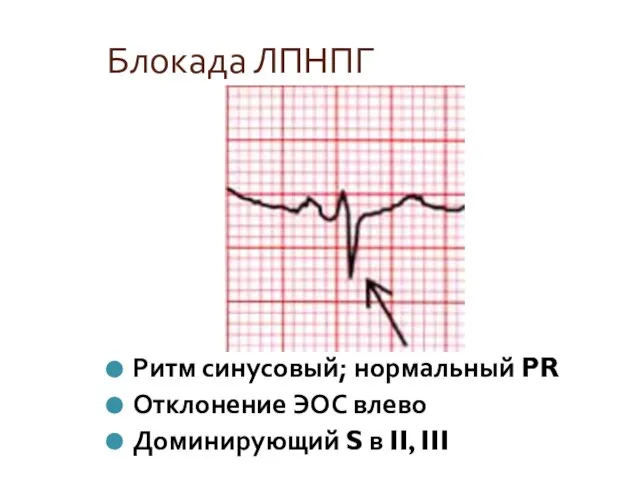 Блокада ЛПНПГ Ритм синусовый; нормальный PR Отклонение ЭОС влево Доминирующий S в II, III