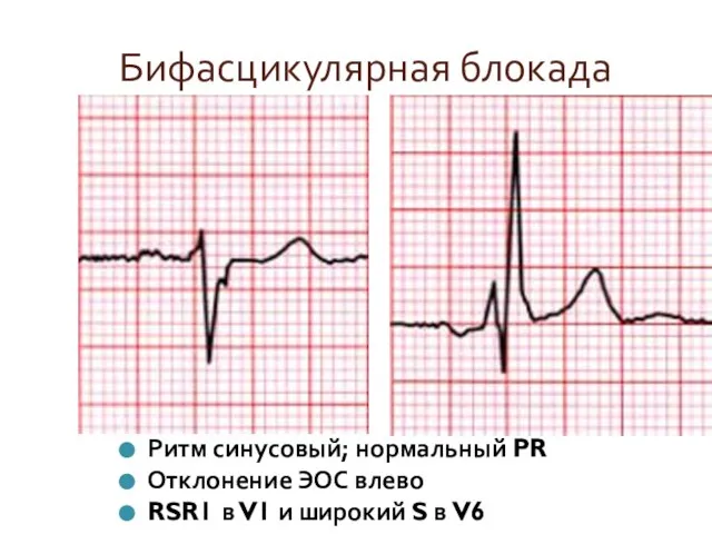 Бифасцикулярная блокада Ритм синусовый; нормальный PR Отклонение ЭОС влево RSR1 в V1