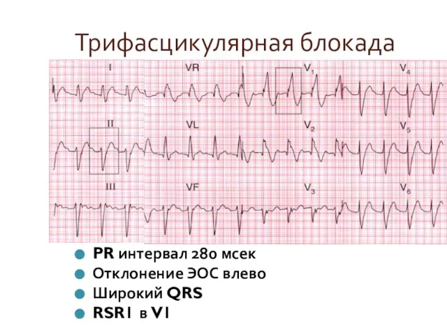 Трифасцикулярная блокада PR интервал 280 мсек Отклонение ЭОС влево Широкий QRS RSR1 в V1