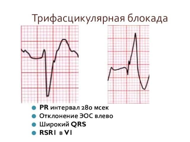 Трифасцикулярная блокада PR интервал 280 мсек Отклонение ЭОС влево Широкий QRS RSR1 в V1