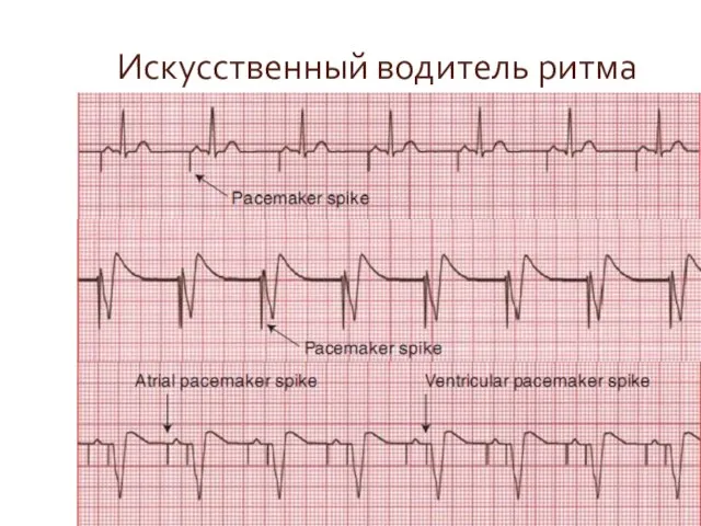 Искусственный водитель ритма